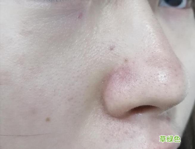 鼻子上有红血丝怎么治疗 鼻子上有红血丝