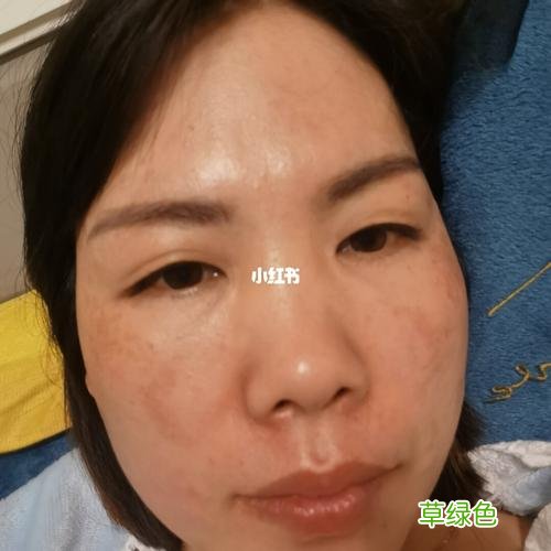 治疗黄褐斑价格 黄褐斑的价格