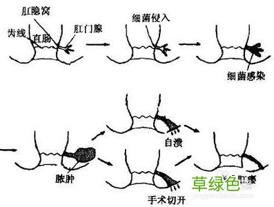 肛周脓肿图片早期症状 肛周脓肿图片