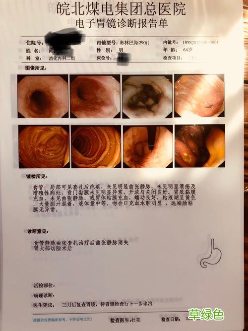 肝硬化晚期怎么治疗效果好 肝硬化晚期的治疗