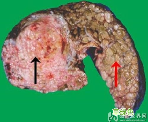 肝硬化能活多久一般知乎 肝硬化能活多久