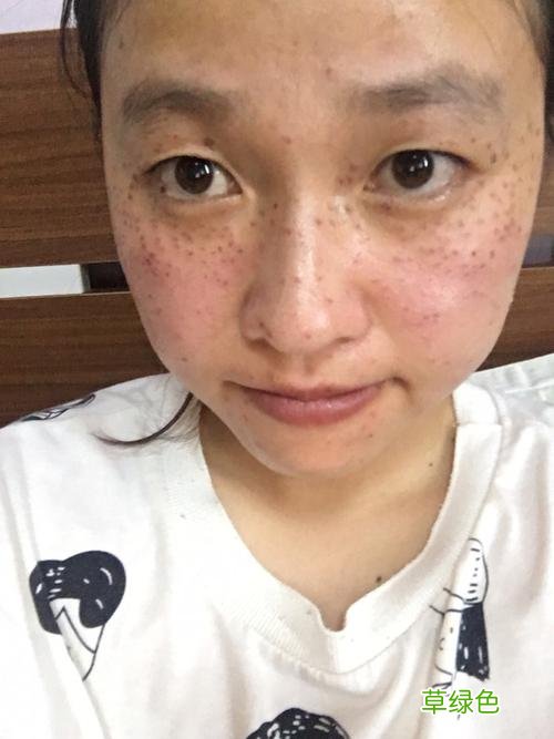 激光祛斑靠谱吗 激光祛斑有危险吗
