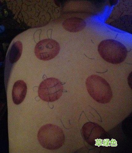 拔火罐有副作用没有 拔火罐的副作用