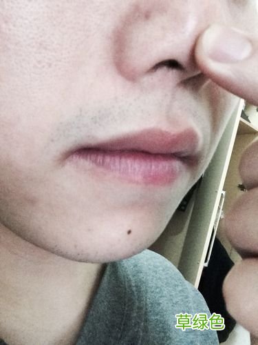 鼻子周围有红血丝是什么原因 鼻子两侧有红血丝