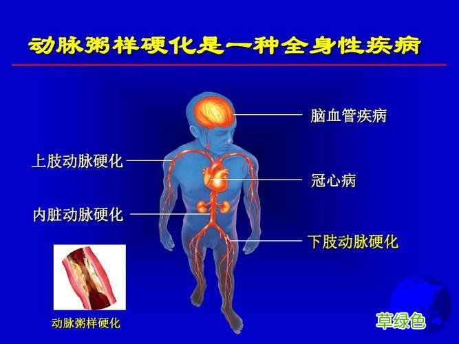 粥动脉硬化的症状和治疗 动脉硬化的治疗