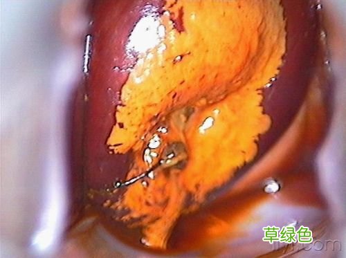 三度宫颈糜烂图高清 宫颈糜烂的图片
