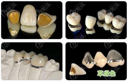 钴铬烤瓷牙使用寿命多久 钴铬烤瓷牙的寿命