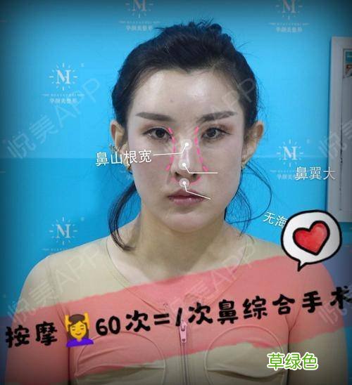 日本缩鼻翼方法 鼻翼缩窄方法