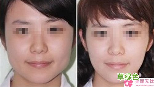 打咬肌多少钱一针 打咬肌多少钱