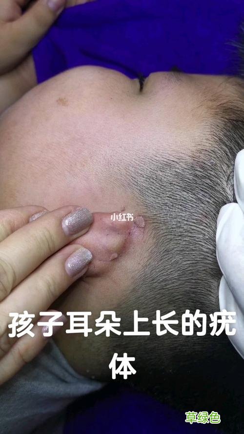 小肉粒疣图片 初期小疣体图片