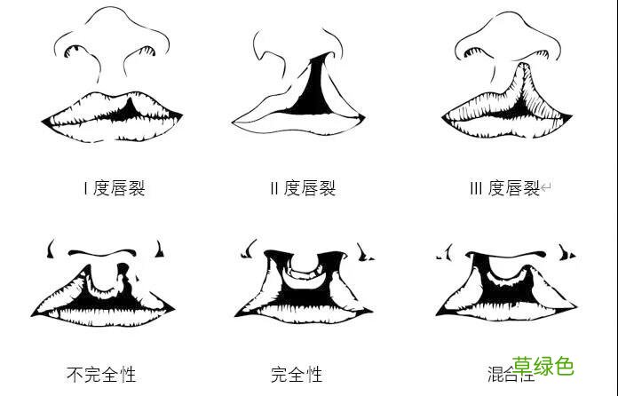 做腭裂手术多少钱 腭裂手术多少钱