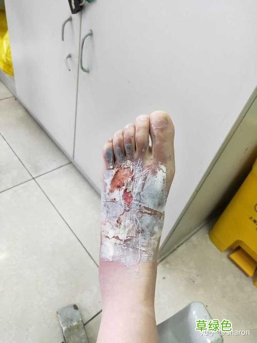 手被开水烫了怎么办最快速最实用 被开水烫了怎么办