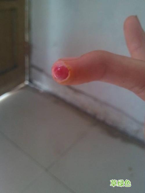 鸡眼膏怎么用 如何正确使用鸡眼膏 鸡眼膏怎么用