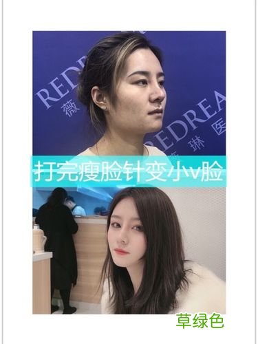 打瘦脸针会不会有影响 打瘦脸针好不好