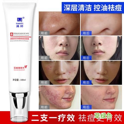 粉刺用什么洗面奶 去粉刺洗面奶