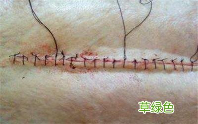 剖腹产正常疤痕图片一年后 剖腹产后疤痕图片