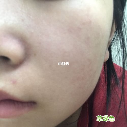 毛孔粗大皮肤暗黄松弛怎么办 毛孔粗大要怎么办