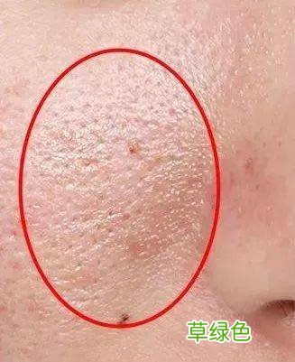 毛孔粗大皮肤暗黄松弛怎么办 毛孔粗大要怎么办
