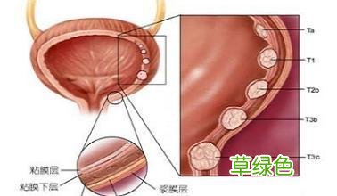 腺性膀胱炎的症状及治疗 膀胱癌晚期症状
