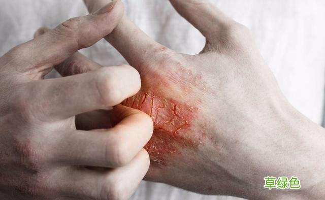 湿疹性皮炎是什么样子的 什么引起湿疹