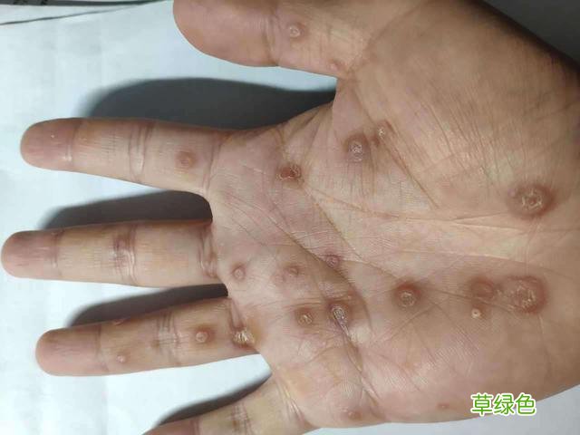 梅毒初期症状图片男性 梅毒初期症状图片