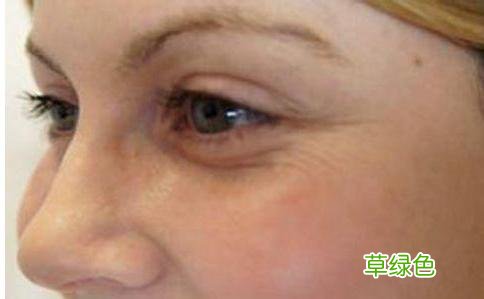 去除眼角鱼尾纹最好的方法 去除眼角鱼尾纹