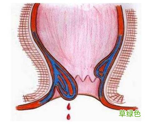 生痔疮怎么解决 生痔疮怎么办