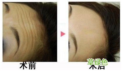 怎么减轻额头上的皱纹 如何去除额头皱纹