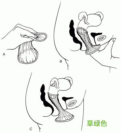 怎样避孕最安全有效又健康 如何避孕最安全