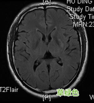 多发性腔隙性脑梗塞 脑干腔隙性脑梗塞