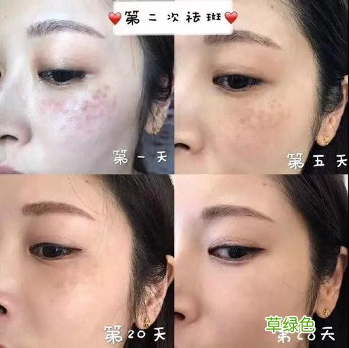 雀斑去除 雀斑的治疗方法