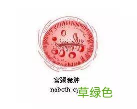 纳氏囊肿有什么症状 什么是纳氏囊肿