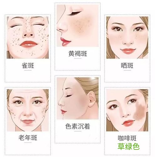 色斑是怎么形成的呢 色斑形成的原因
