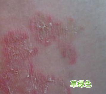 皮肤癌晚期一定会死吗 皮肤癌会死吗