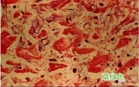 什么叫败血症又有什么生命危险 什么叫败血症