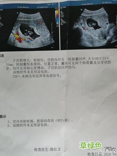 怎么样可以怀上双胞胎 生双胞胎的秘诀