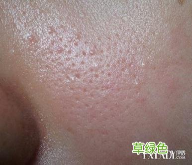 毛孔粗大红红的怎么办 毛孔很粗怎么办