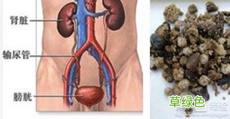 膀胱结石有哪些症状 尿结石有哪些症状