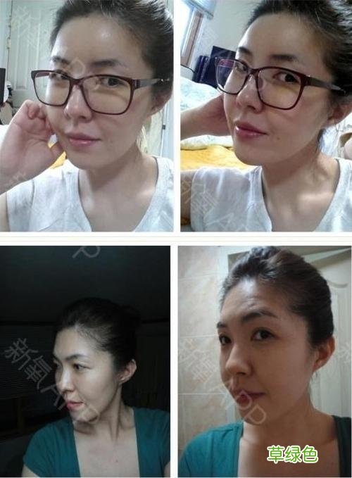 去鼻唇沟最有效的办法 去鼻唇沟多少钱