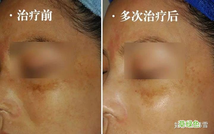 黄褐斑怎么消除 祛黄褐斑的方法