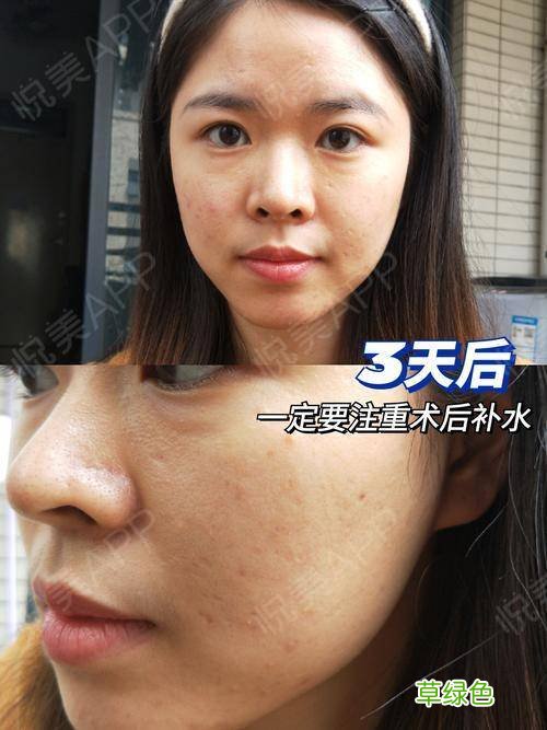 毛孔粗大如何解决办法 毛孔粗大该怎么办