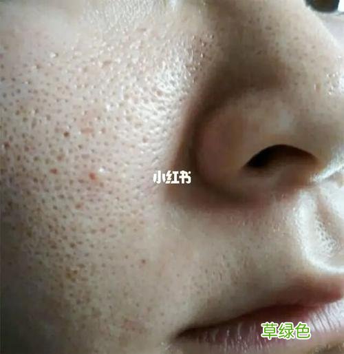 毛孔粗大如何解决办法 毛孔粗大该怎么办