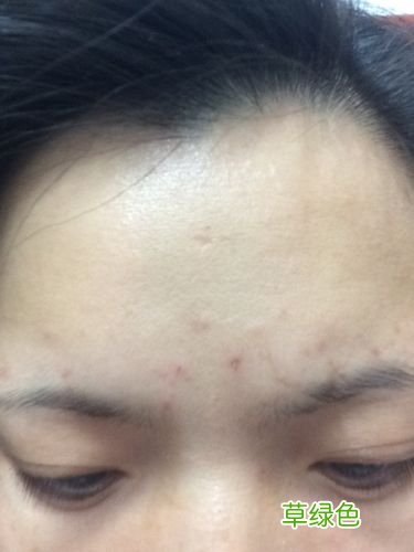 眉毛里面长痘痘很痛怎么办 眉毛里长痘痘