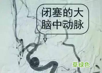 如何治疗脑血管堵塞 脑血栓如何治疗