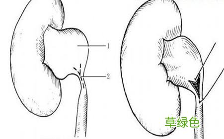肾积水的最佳治疗方案 肾积水的治疗