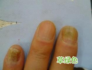 如何治灰指甲 如何根治灰指甲