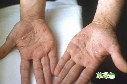 梅毒的潜伏期最长多少年能发作 梅毒的潜伏期