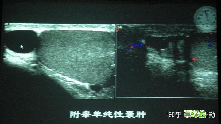卵巢囊肿是什么引起的 囊肿是什么引起的