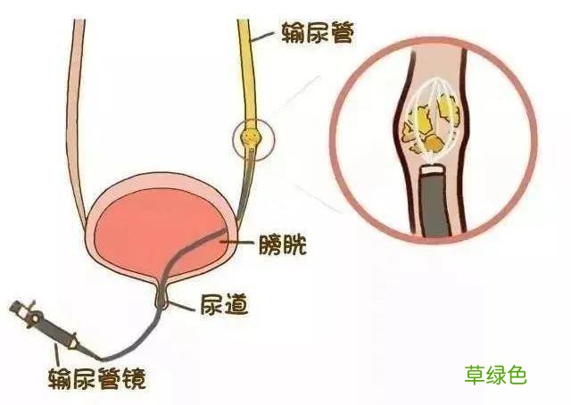 尿结石的症状男性会影响性生活吗 尿结石的症状