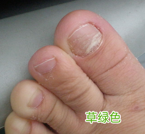 灰指甲的症状 灰指甲的症状图片